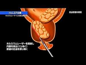 「医テレ」2011年09月24日放送 前立腺肥大症 ＨｏＬＥＰ（ホーレップ）治療