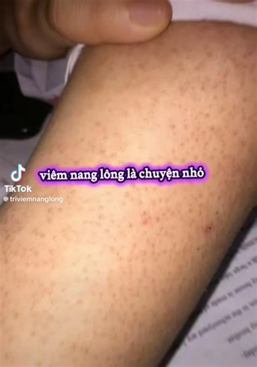 Bí quyết trị viêm nang lông, dày sừng nang lông và da phục hồi khỏi hết hoàn toàn khi được trị chuẩn