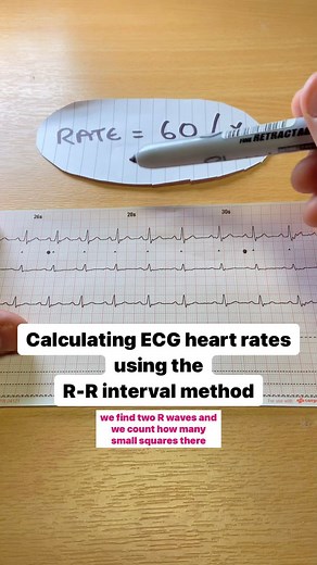 The Medical Lounge on Instagram: "How to calculate a heart rate on an ECG using the R to R interval method ⚠️only to be used on regular rhythms . . 👊 Hit follow & like for more prehospital content . . 🖥️ head over to www.themedicallounge.co.uk and sign up for incoming educational courses and quizzes. . . 🛒 Head over to our Etsy shop www.themedicallounge.etsy.com for prehospital products . . Links also in bio . . #ecgchallenge #ecginterpretation #ecglovers #ecgreading #ecglearning #paramedic🚑