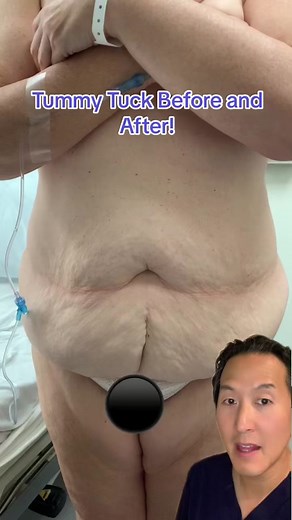 Tummy tuck before and after! I took 10 lbs off her abdomen. Check out her 4 month results! #tummytuckjourney #tummytuck #plasticsurgeon #plasticsurgerybeforeandafter