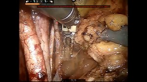 Stepwise Robotic Pelvic Lymphnode Dissection