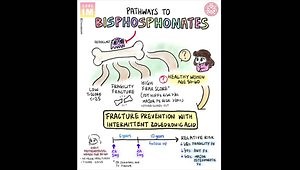 Bisphosphonates and Fracture Prevention Trial: Beyond Journal Club With NEJM Group