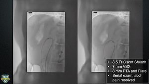Technical Tips for Complex SMA Recanalization and Stenting