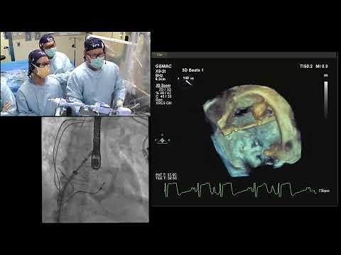 TMVR in MAC with ARCTIC procedure (clip + valve). [transcatheter mitral valve replacement]
