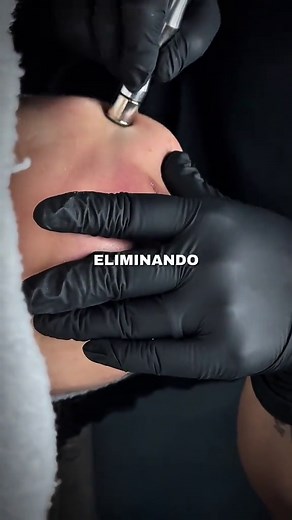 Microdermoabrasión: Beneficios y Procedimiento