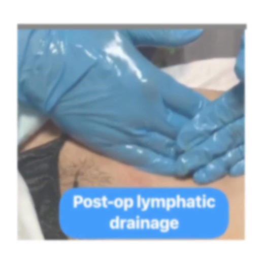 Qu’est-ce que le drainage lymphatique manuel? C’est une technique de massage qui a pour but d’activer le système lymphatique. Comment se fait le drainage lymphatique? 👉Sans huile 👉Avec des manœuvres lentes et répétitives 👉Avec un toucher léger qui fait bouger la peau seulement 👉Sans glisser sur la peau Le drainage lymphatique ne cause pas douleur. Des manœuvres trop rapides ou trop profondes n’activent pas le système lymphatique. De même que la douleur diminue l’activité du système lymphatiq
