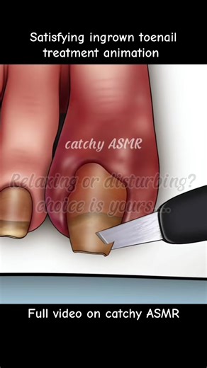 Relaxing Ingrown Toenail Treatment Animation