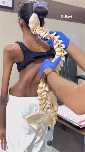 Best scoliosis with Marfan syndrome treatment by DrRavi #scoliosis #marfansyndrome #chiropractic