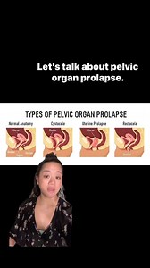Pelvic organ prolapse occurs when the structures within the pelvis...