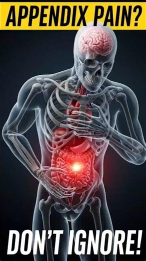 Appendix Pain? Don’t Ignore This! ⚠️🔥 #appebdixpain #appendicitis # healthtips #health #abdomenpain