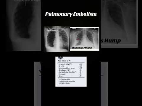 Pulmonary Embolism/ Step 2CK High Yield facts 