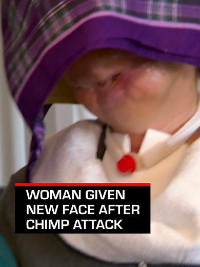 Charla Nash: A Life Transformed by a Face Transplant