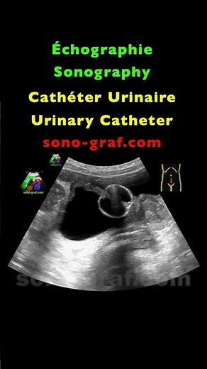 Échographie - Cathéter Urinaire