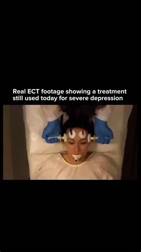 AI • Technology • Innovation on Instagram: "Electroconvulsive Therapy sends carefully controlled electrical currents through the brain to trigger a brief, therapeutic seizure. Today the procedure is performed under general anesthesia with muscle relaxants, meaning the patient feels no pain during treatment. ECT is still used for severe depression and other psychiatric conditions when medications and therapy fail. Despite its portrayal in old films, modern ECT is highly regulated, evidence based,