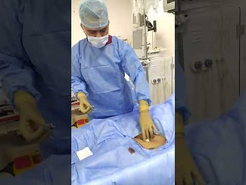 how to insert femoral Catheter in Dialysis patient Procedure of Femoral #catheterization