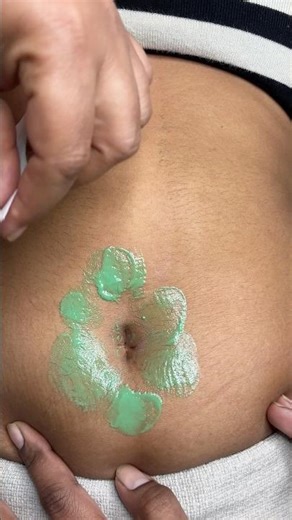 Navel hair waxing with fun/ #prebridalskincare #tummywaxing #ricawax #hairremoval ‪@pummybeautyworld‬