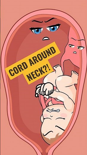 Baby’s Cord Was Wrapped Around Her Neck?! 😱 #pregnancy #animation