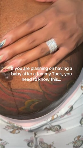 Richie on Instagram: "1. Wait Before Conceiving Wait at least 6-12 months after surgery for full tissue and muscle healing before trying to conceive. This minimizes risks to incisions during pregnancy expansion. 2. Pregnancy Is Safe Your prior tummy tuck doesn’t endanger you or the baby; the abdomen can stretch as needed. Safety focuses on medical rather than aesthetic factors. 3. Results May Change Pregnancy can stretch skin, separate muscles, and undo contours, often needing revision surgery. 
