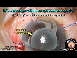 CataractCoach™ 1898: IOL exchange with open posterior capsule