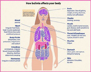What is Bulimic Nervosa?