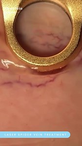 20K views · 99 reactions | Laser spider vein removal in under 30 minutes! Excel V+ laser is 100% non-invasive and targets spider veins, skin discoloration, and other vascular conditions on the surface of the skin. Want to learn more? Give us a call at 866-353-5205. We’ve got you covered. . . . #SpiderVeins #laser #LaserVeinRemoval #SpiderVeinLaser #vein #veins #TreatmentInAction | Metro Vein Centers | Facebook