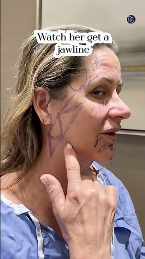 Natural Results| Face and Neck Lift 2 Months Post-Op| Before and After