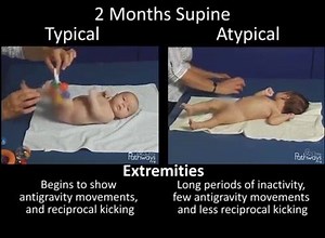 It can be hard to know what’s typical and atypical movements at 2 months old. Here’s a side-by-side comparison to help you out! Stay tuned for next week where we’ll show 4 month typical/atypical movements! #watchthiswednesday https://pathways.org/topics-of-development/motor-skills-2/milestones/ | Pathways.org