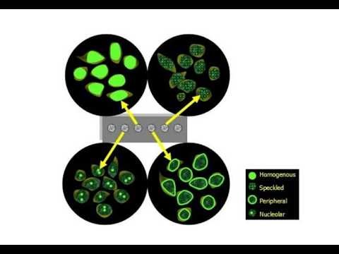 ANA antinuclear antibody; autoantibodies that target proteins in the nucleus of cells