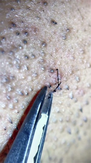 It grew back a day later !!! #asmr #satisfying #tweezer