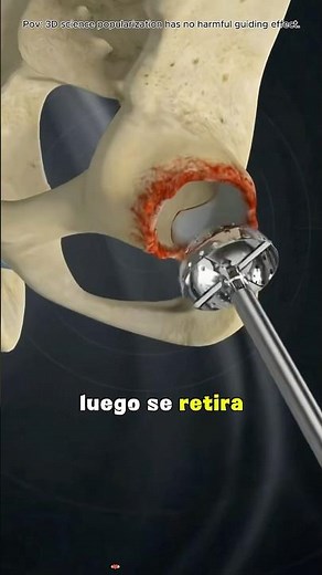 How Anterior Hip Replacement Surgery Is Performed? (3D Animation)#hipreplacement #hipreplacment