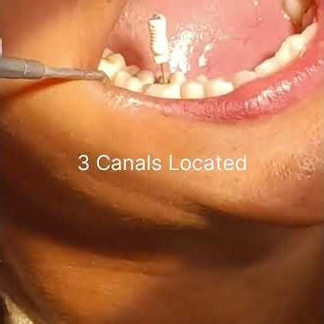 Severe Tooth Pain Relief in Minutes 😱 Root Canal TreatmentStepbyStep #dentist #TheDentalGuru#shorts