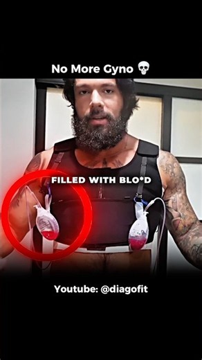 Bro Finally Got Rid of It 👀 #gyno #surgery #fitness