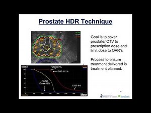 2017 11 21 17 30 HDR prostate brachytherapy technique