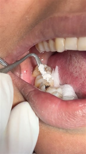 temporary filling #dental #dentist