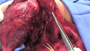 Ewing's Sarcoma of Scapula Treated with a Limb-Sparing Resection and Total Scapula Prosthetic Reconstruction (Pediatric)