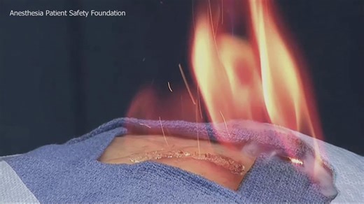 Operating room fire at OHSU caused minor injury to patient