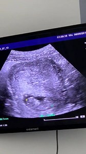24K views · 3.1K reactions | Our last ultrasound - 11 weeks and baby is moving around. We don’t know the sex yet - but he/she is developing his/her facial features (including cute nose) and already has all his/her fingers & toes. Sorry for the low quality here, but wanted to share. We’re so incredibly excited. | Lila Rose | Facebook