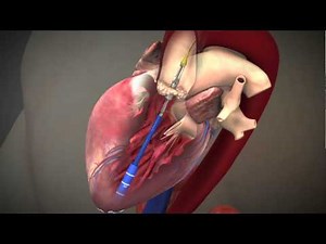 TA Procedure （TAVI 経心尖アプローチ）