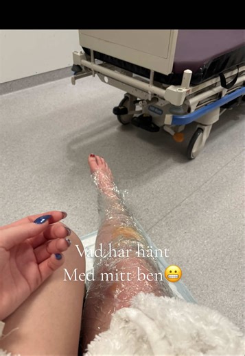 Burn Accident Recovery: My Leg Story