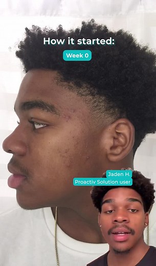 A consistent routine is the fastest way to get great results!! Tag us in your skincare journey! 💙 #beforeandafter #skintok #proactiv #proactivjourney