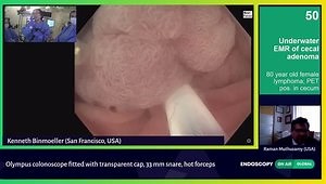 Underwater EMR for Cecal Adenoma