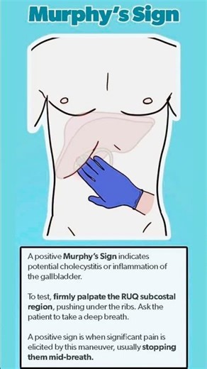 Murphy’s Sign clinical test used in diagnosing acute cholecystitis or gallbladder inflammation