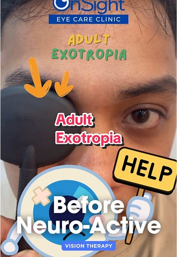 Understanding Adult Exotropia and Binocular Vision Disorders