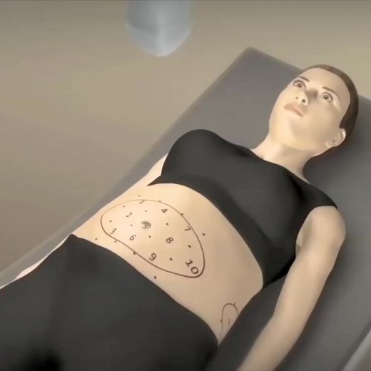 💥 ¿Grasa localizada que no se va con nada? Conocé Liposonix: la tecnología de Estados Unidos que está revolucionando los tratamientos estéticos. 🔥 También conocida como “Liposucción sin cirugía”, Liposonix utiliza ondas de ultrasonido focalizado para destruir la grasa de forma precisa y segura, sin dañar la piel ni otros tejidos. 📉 Resultados visibles desde la primera sesión ⏱️ Sin cortes, sin agujas, sin tiempo de recuperación 💪 Ideal para abdomen, flancos, brazos y más! ✨ ¡Cuidate sin pasa