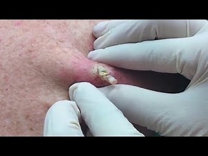 Blackheads Removal | Acne Treatment Full Screen