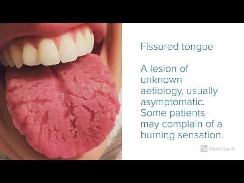 Oral Pathology : 5 Tongue Leisons You Must know