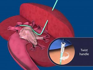 PCNL Simplified Animation
