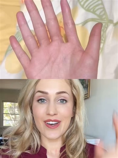 Yes, some people are born with 6 fingers! #polydactyly #polydactyl #fingers #doctor