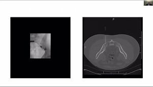 Advanced Techniques in Treating Isolated Sacral Fractures