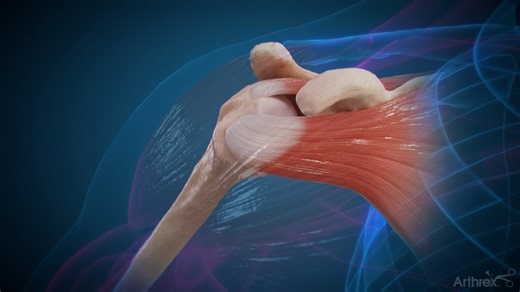 2.9K views · 33 reactions | This animation provides a brief review of anatomic shoulder replacement and how it can be used to treat osteoarthritis of the glenohumeral joint. Learn more about how shoulder replacement surgery using Arthrex’s less-invasive, patient-specific technologies may provide relief: https://arthrex.info/41GfT4E #MedicalEducation #Innovation #Arthroplasty #ShoulderReplacement | Arthrex | Facebook